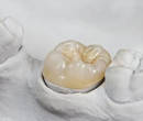 STUDIO DENTISTICO DOTT. PAOLA DEL BIANCO - Bagni di Lucca (LU) - Realizzazione Corone Dentali